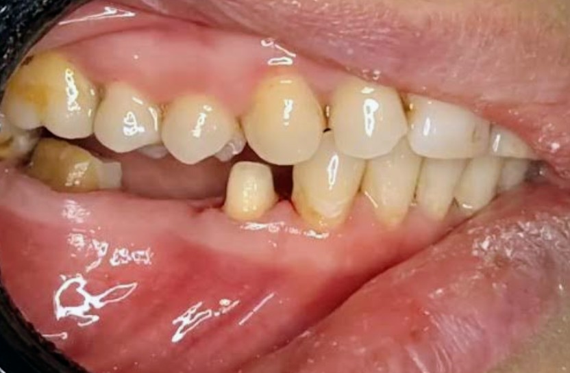 Implant & Crown — before