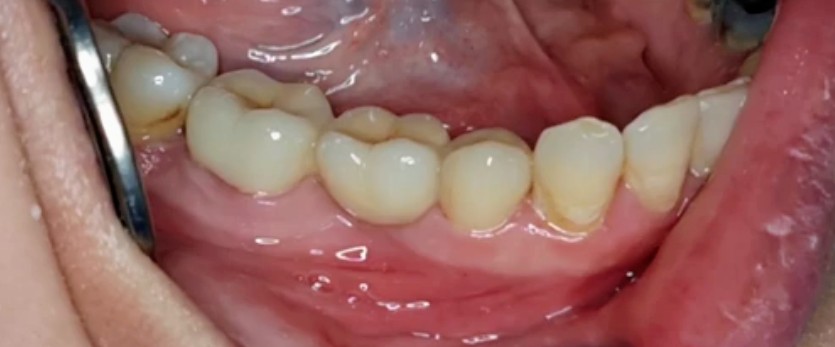 Implant & Crown — after